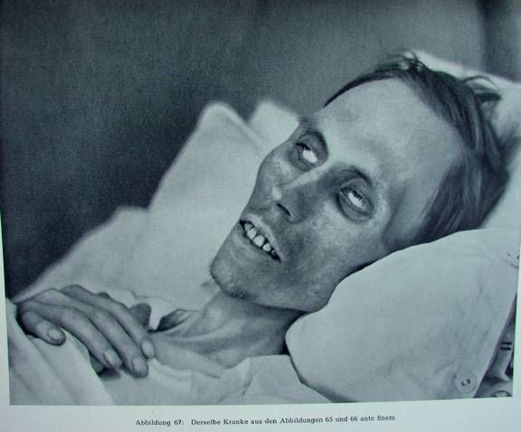 Жесть! Фотографии смертельно больных людей.